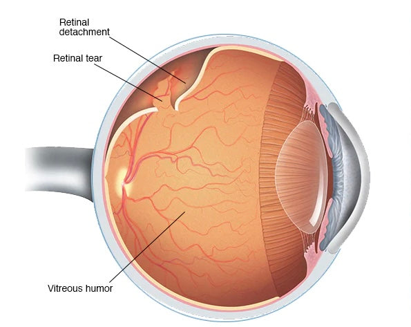 Myopia atau rabun jauh yang tinggi berisiko menghidapi lekangan pada retina!