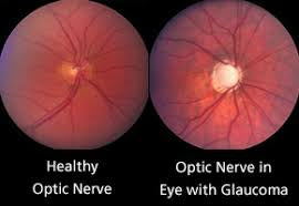 Glaukoma berkait dengan tekanan mata yang tinggi!