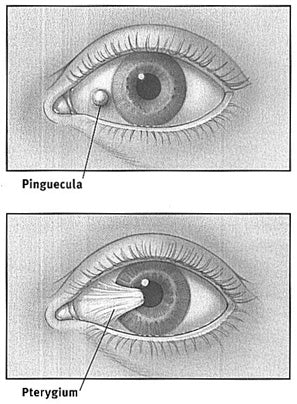 Tahukah anda apa itu Selaput Luar mata iaitu Pinguecula dan Pterygium?