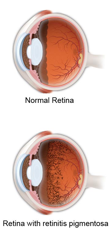 Penyakit keturunan? Penglihatan menjadi sempit? Jom ketahui apa itu retinitis pigmentosa!