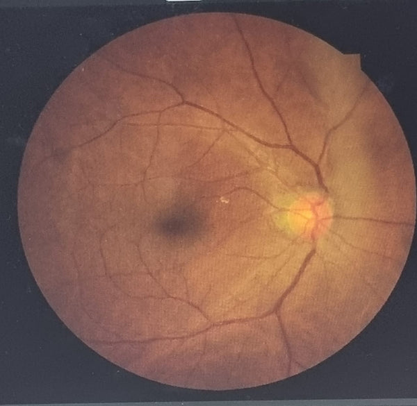 Penyakit darah tinggi boleh memberi kesan pada mata?